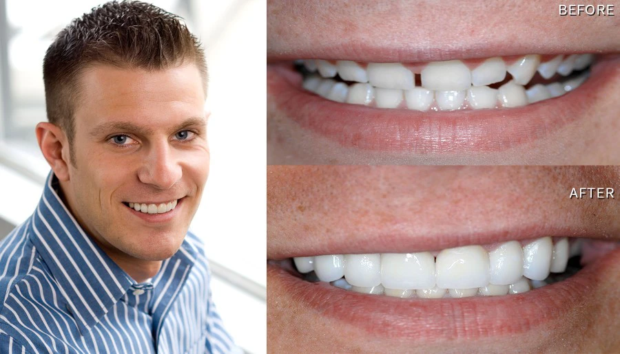 Smile Before And After Porcelain Laminate Veneers Brian