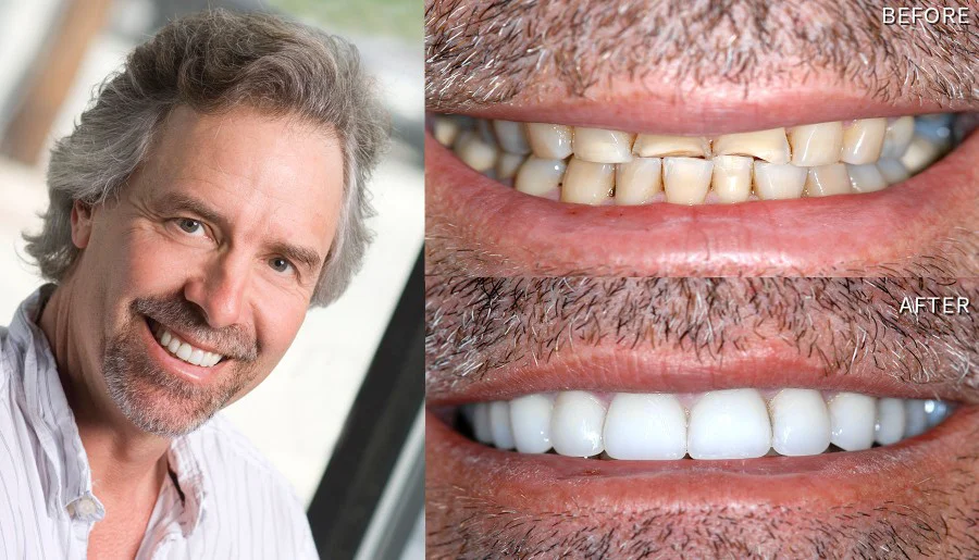 Smile Before And After Smile Makeover Bruce