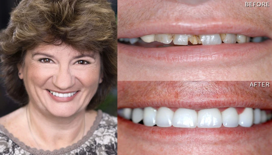 Smile Before And After Dental Implants Diana