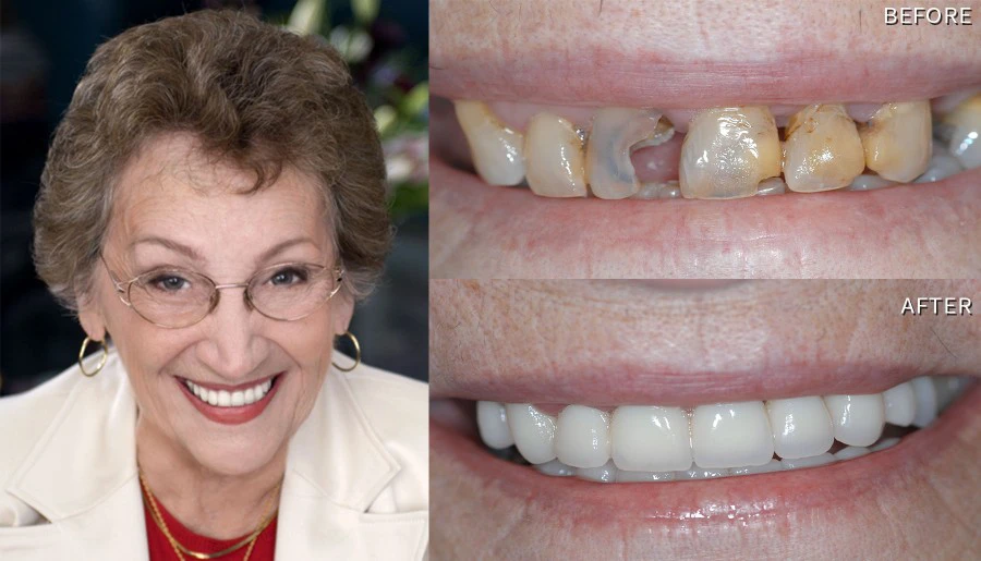 Smile Before And After Smile Makeover Frances