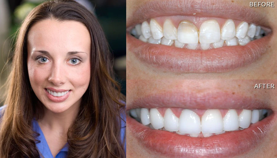 Smile Before And After Smile Makeover Jessica
