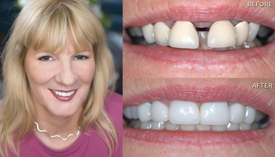 Smile Before And After Porcelain Laminate Veneers Pam