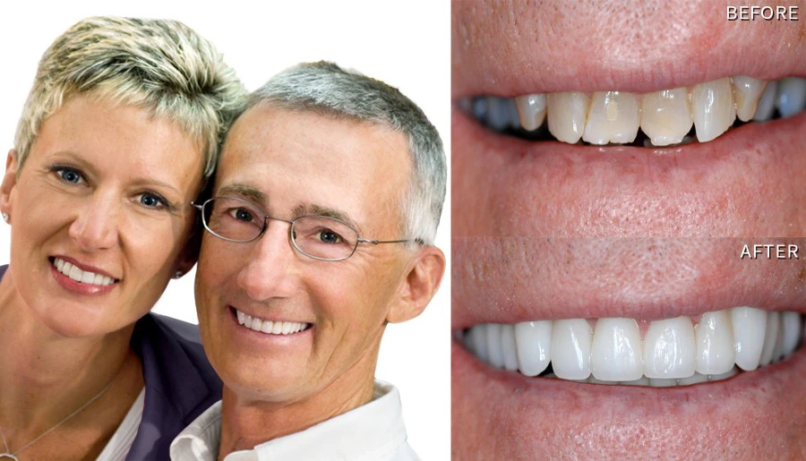 Smile Before And After Smile Makeovers Reneé & William